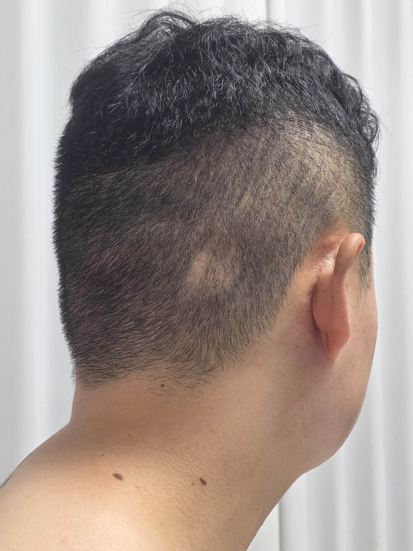 뒤통수에 원형탈모가 생긴 모습